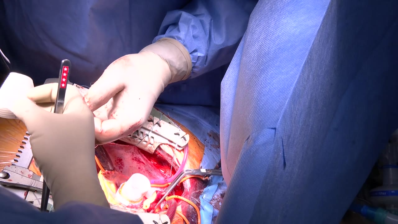 В Костроме прошла первая операция на открытом сердце